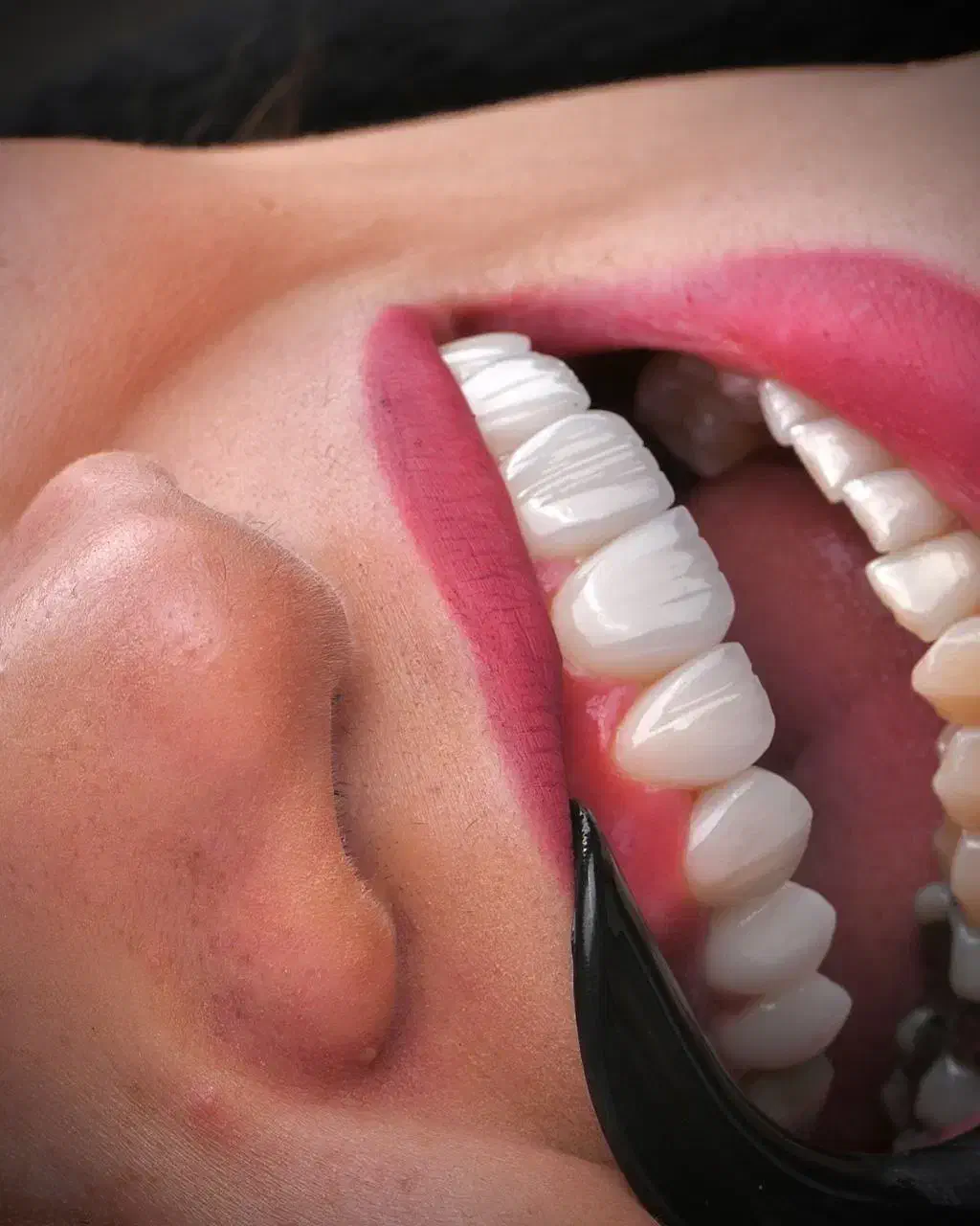 دندان پزشکی ایمپلنت روکش ارتودنسی اقساطی|خدمات آرایشگری و زیبایی|مراغه, |دیوار