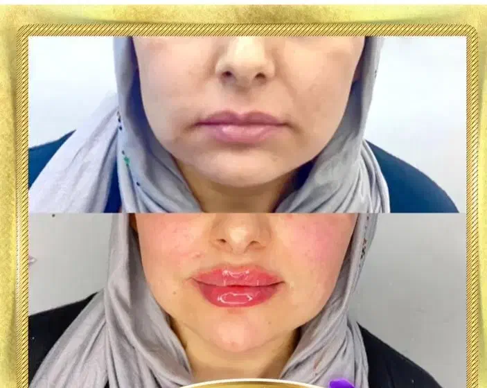 آموزش فیشیال،ژل بوتاکس برای آقاها،خانم هفده شهریور|خدمات آموزشی|تبریز, |دیوار