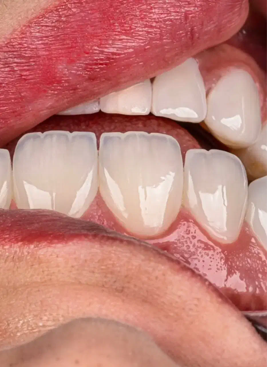 کامپوزیت دندان روش لیرینگ با ضمانت|خدمات آرایشگری و زیبایی|مشهد, فلسطین|دیوار