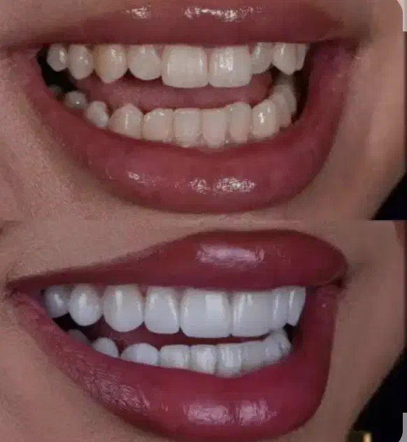 کامپوزیت دندان|خدمات آرایشگری و زیبایی|دورود, |دیوار