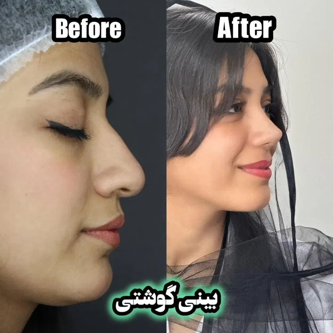 عمل بینی/جراحی بینی|خدمات آرایشگری و زیبایی|جهرم, |دیوار