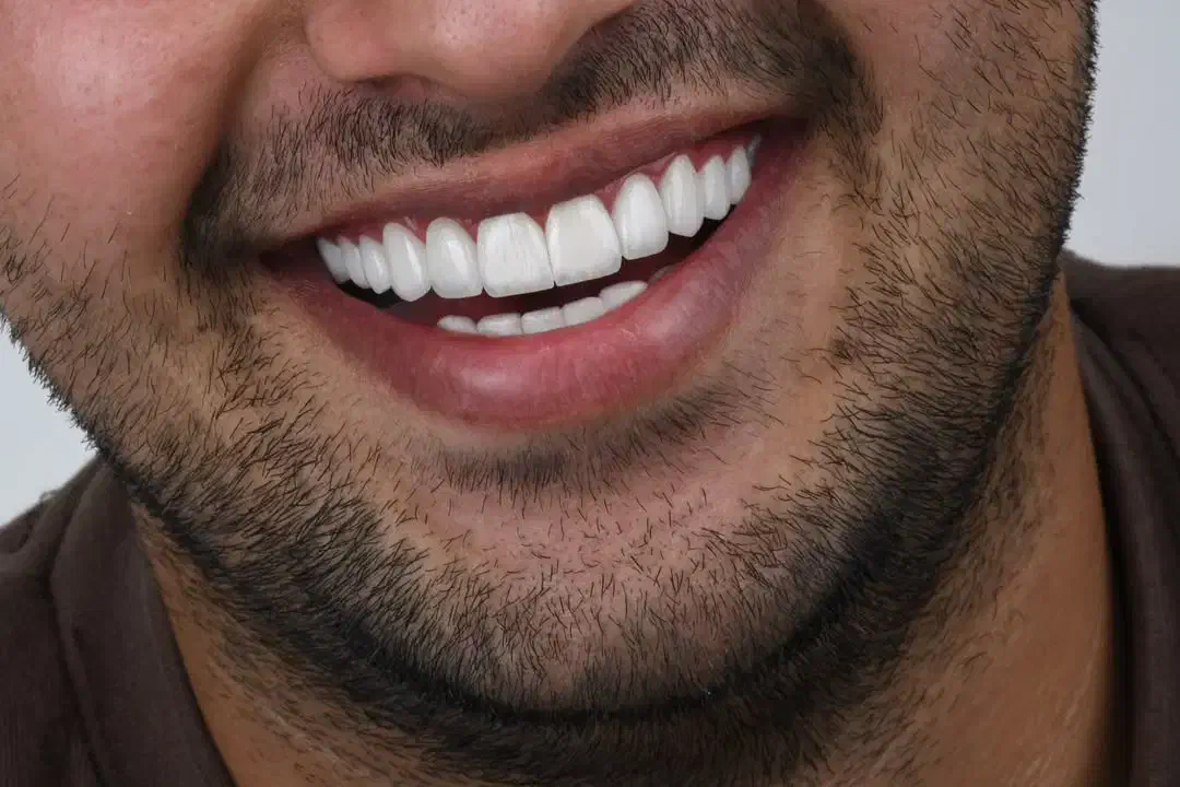 ایمپلنت دیجیتال|خدمات آرایشگری و زیبایی|شیراز, خلیلی|دیوار