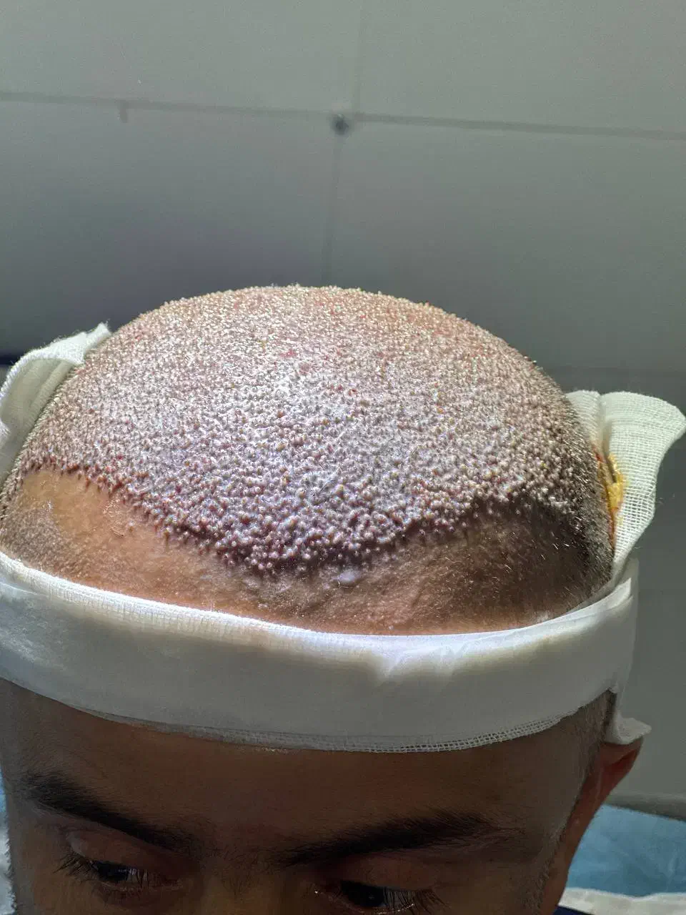 کاشت مو پر تراکم|خدمات آرایشگری و زیبایی|جهرم, |دیوار