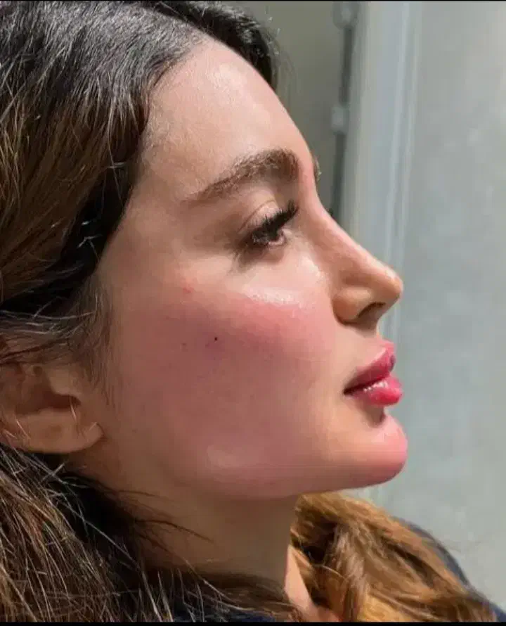 تخفیفات بلک فرایدی ژل و بوتاکس درمطب|خدمات آرایشگری و زیبایی|خرم‌آباد, |دیوار