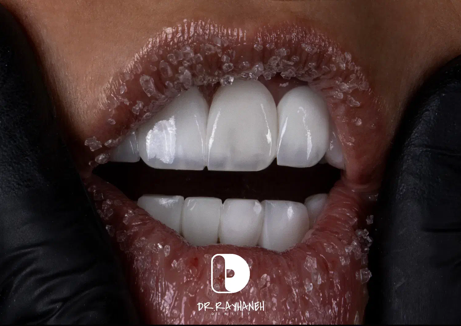 کامپوزیت دندان.لمینت|خدمات آرایشگری و زیبایی|مشهد, کوثر|دیوار