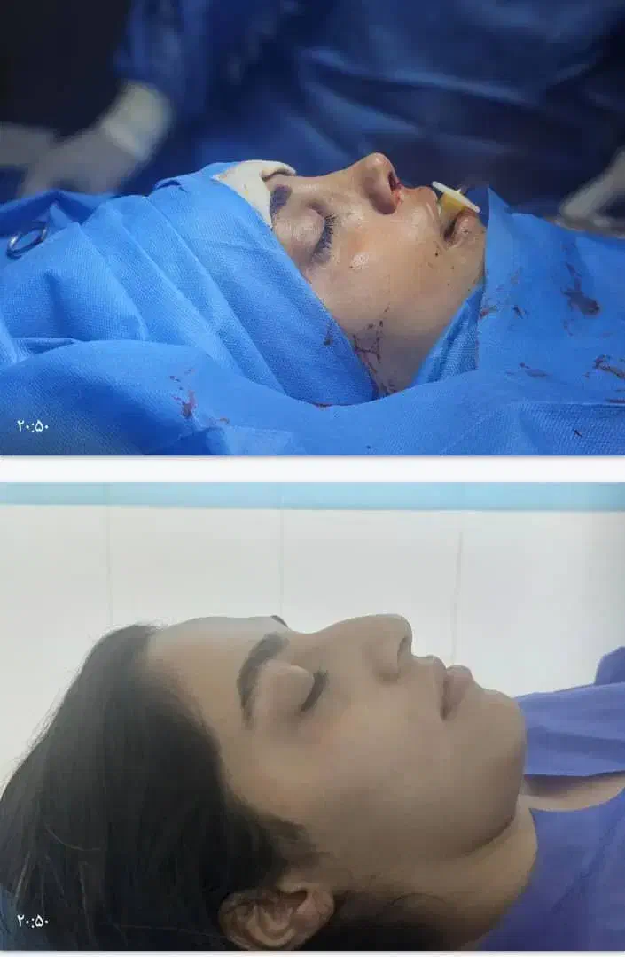 عمل زیبایی بینی در مازندران|خدمات آرایشگری و زیبایی|قائمشهر, |دیوار