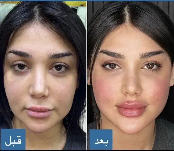 تخفیف تزریق ژل و بوتاکس برای خانم ها و آقایون|خدمات آرایشگری و زیبایی|شاهینشهر, خانه کارگر|دیوار