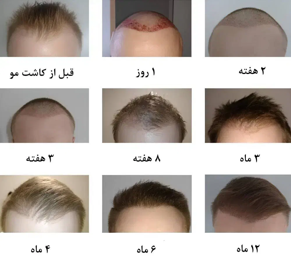 کاشت مو وزیبایی بدن اقساطی|خدمات آرایشگری و زیبایی|تبریز, |دیوار