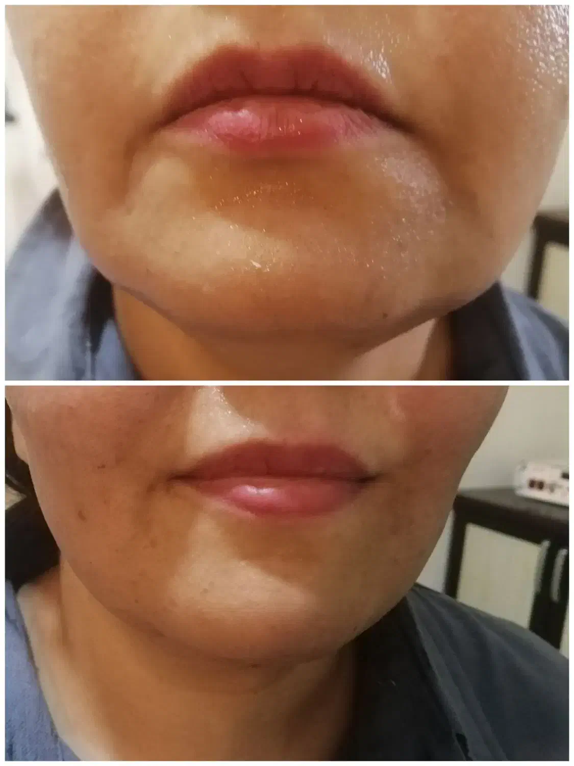 لیفت صورت و جوانسازی در یک جلسه|خدمات آرایشگری و زیبایی|شیراز, زند|دیوار