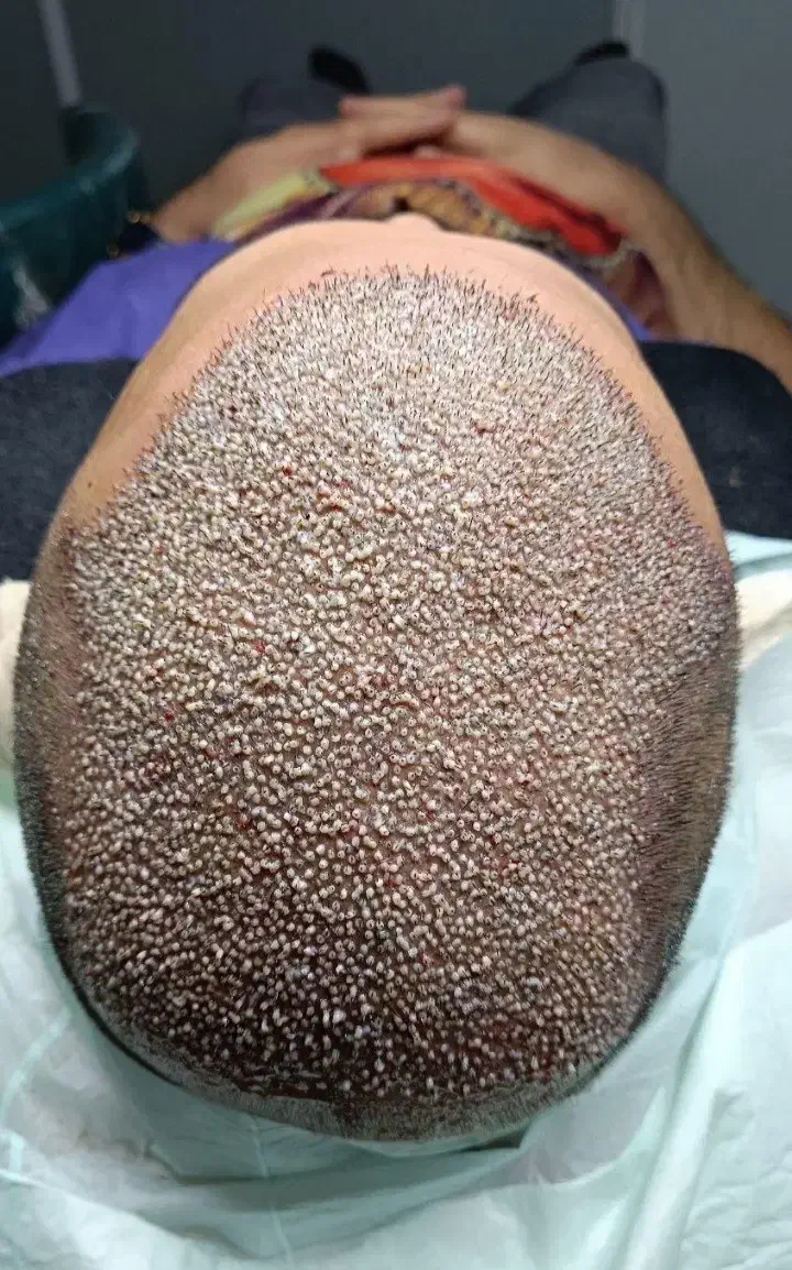 کاشت مو / ریش|خدمات آرایشگری و زیبایی|خرمآباد, |دیوار