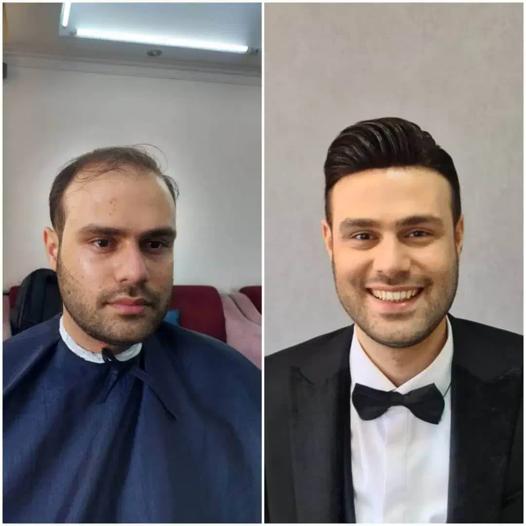 پروتزمو/ تعویض چسب/تخفیف ویژه|خدمات آرایشگری و زیبایی|شیراز, فرگاز|دیوار