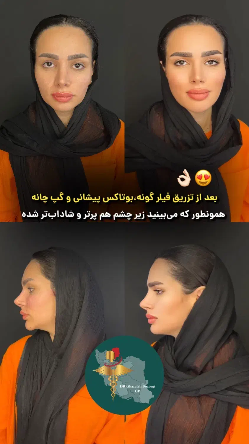 نیاز فوری به مانکن جهت تزریق بوتاکس و فیلر لب|خدمات آرایشگری و زیبایی|تهران, امانیه|دیوار