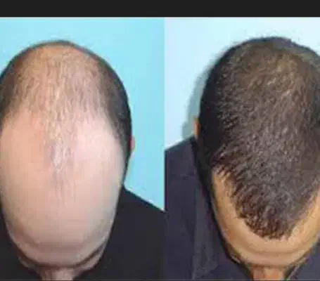 رزماری گیاهی برای کسانی که مو میریزه|گل و گیاه طبیعی|خرمشهر, |دیوار