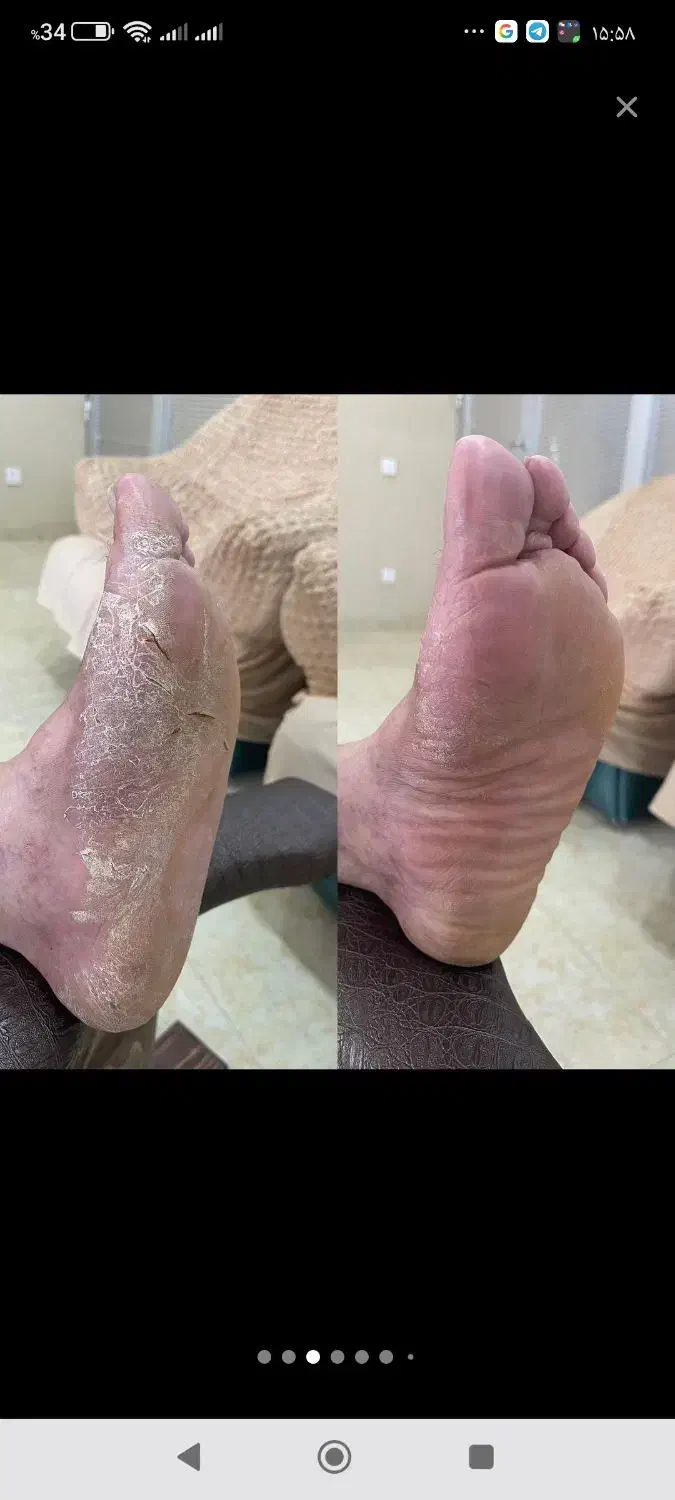 بدون برگشت و دائمی درمان بیماری پوستی|خدمات آرایشگری و زیبایی|گنبد کاووس, |دیوار