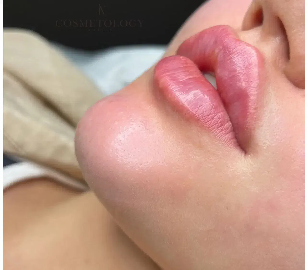 ژل لب گونه چانه،فول فیس لیفت نخ/لیزرآنزیم بوتاکس|خدمات آرایشگری و زیبایی|مشهد, هفت تیر (آب و برق)|دیوار