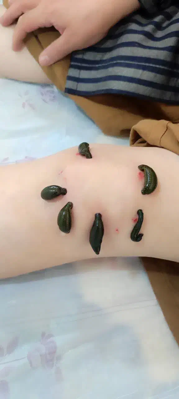 طب سوزنی،زالو درمانی،حجامت|خدمات آرایشگری و زیبایی|تربت جام, شهید نصرالهی|دیوار