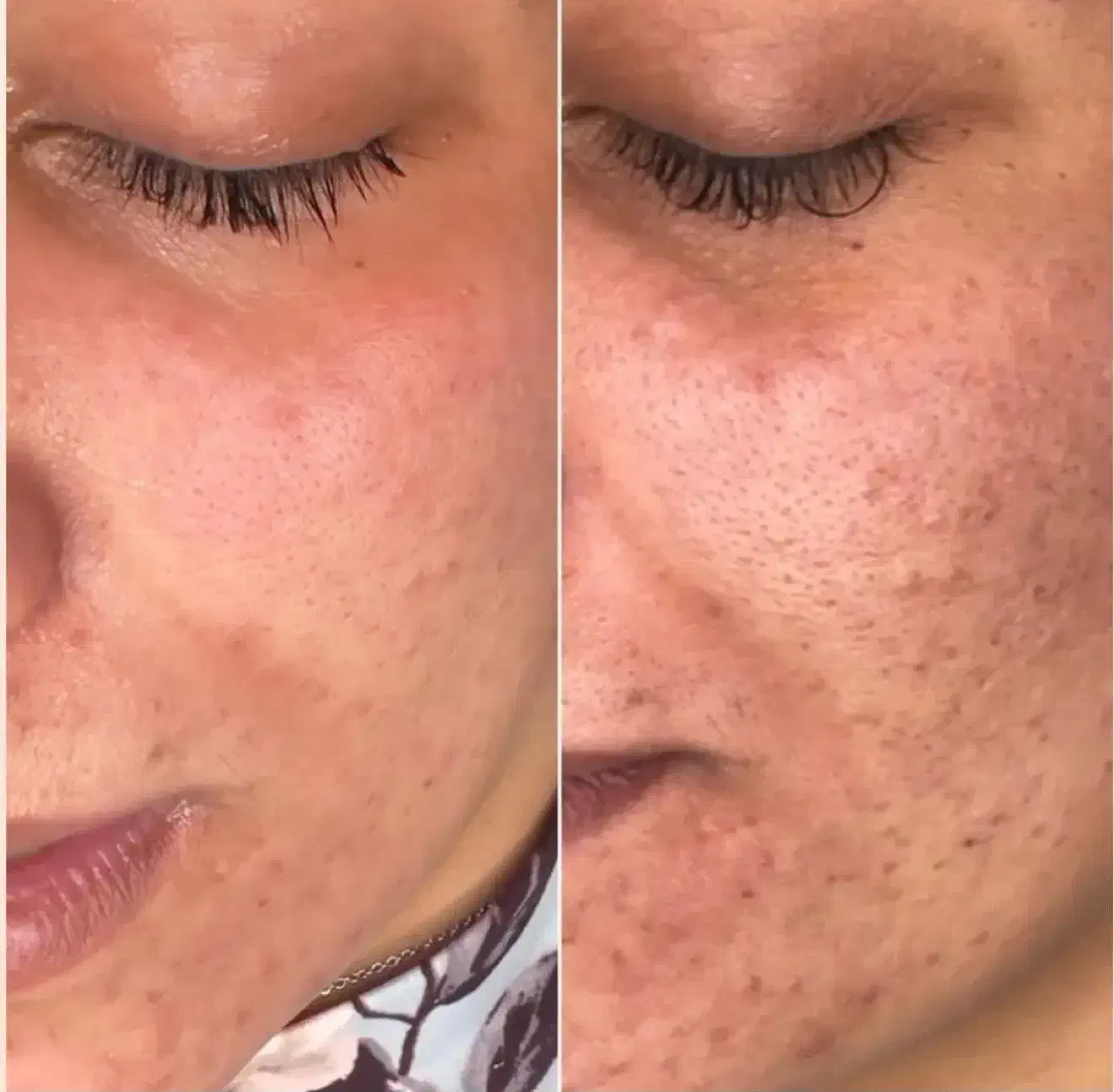 پاکسازی ۱۲مرحله با هدیه درما ۱۹۸ تومان( کلینیک)|خدمات آرایشگری و زیبایی|بیرجند, |دیوار