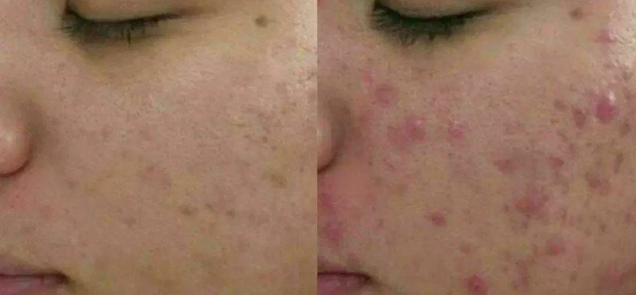 پوستت صورت زیبا کن|آرایشی، بهداشتی، درمانی|خرمآباد, |دیوار