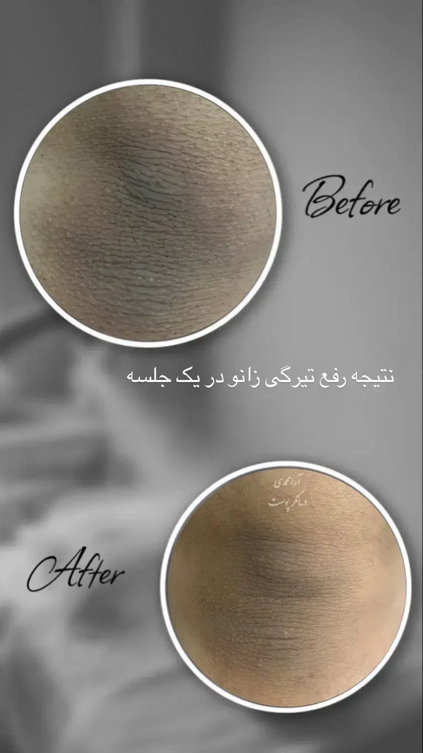 درمان پوست باتخفیف بلک فرایدی/پوست کره‌ای/کاموفلاژ|خدمات آرایشگری و زیبایی|پاکدشت, پاکدشت (مامازند)|دیوار