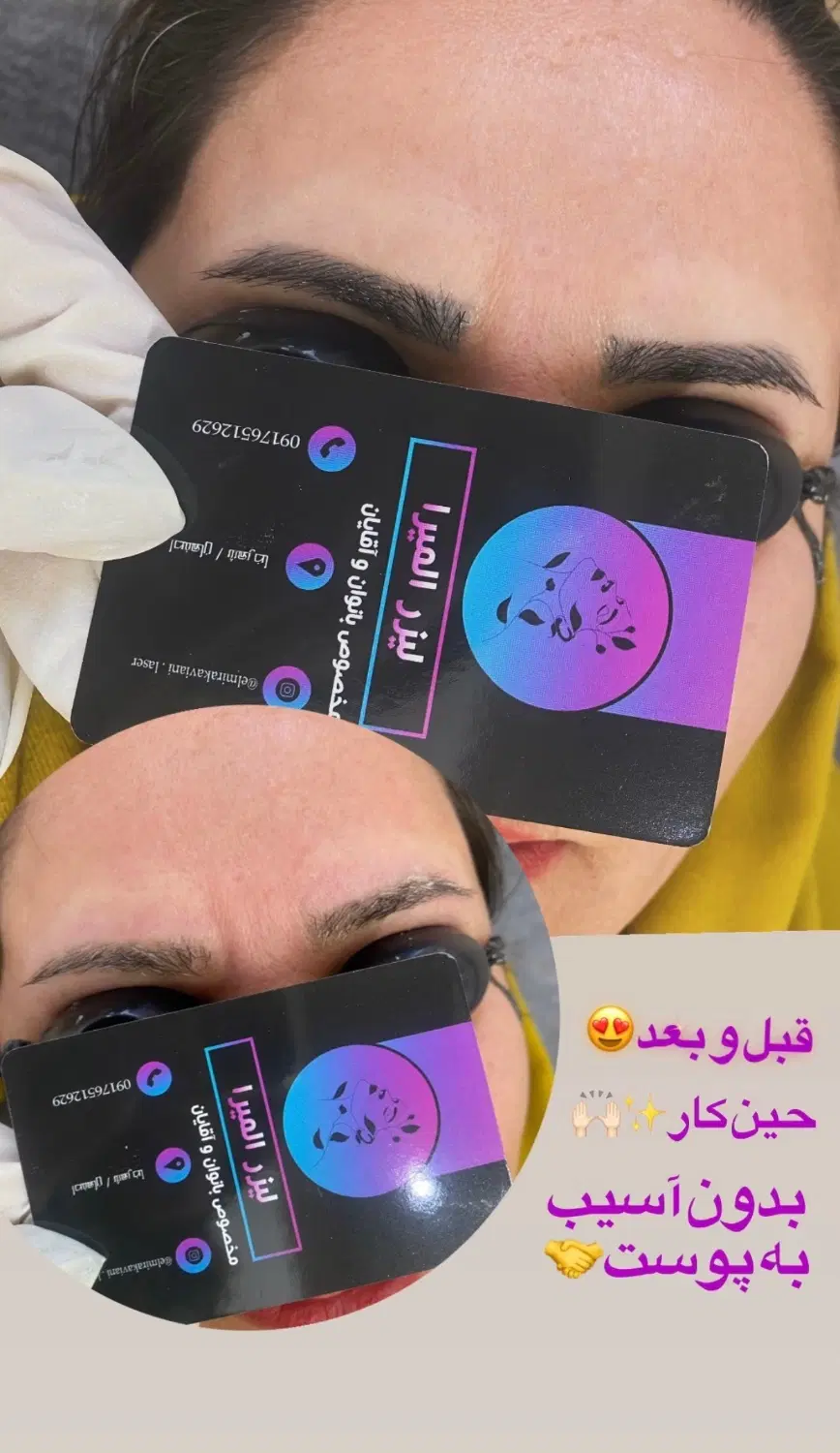 لیزر|خدمات آرایشگری و زیبایی|شهرضا, |دیوار