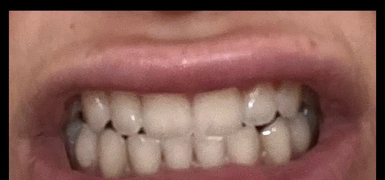 کامپوزیت دندان فکی ۸تومن|خدمات آرایشگری و زیبایی|تهران, والفجر|دیوار