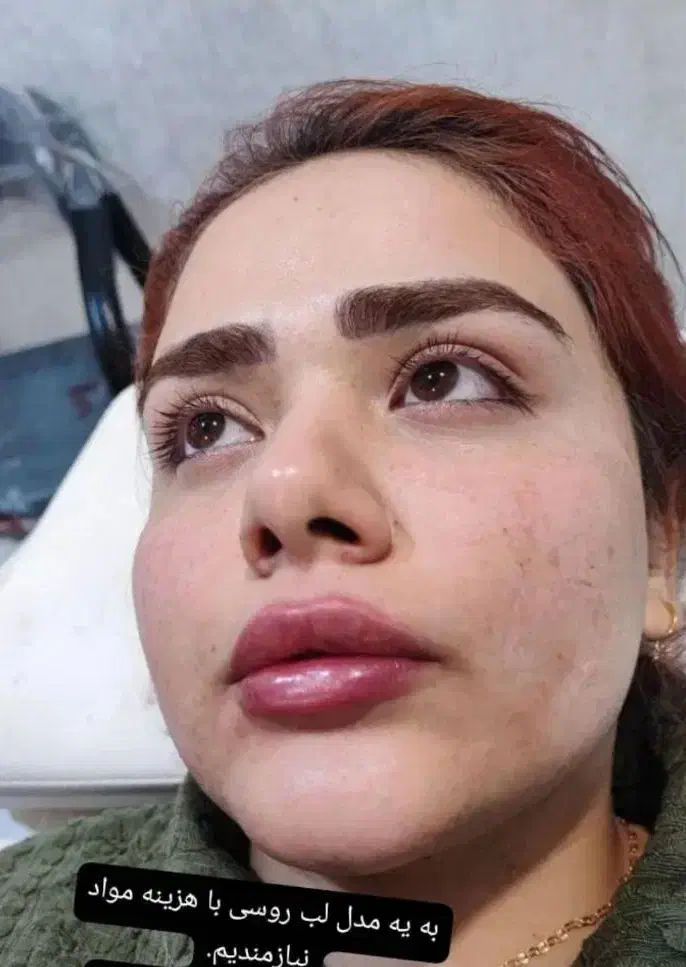 تزریقات ژل و بوتاکس|خدمات آرایشگری و زیبایی|دوگنبدان, |دیوار