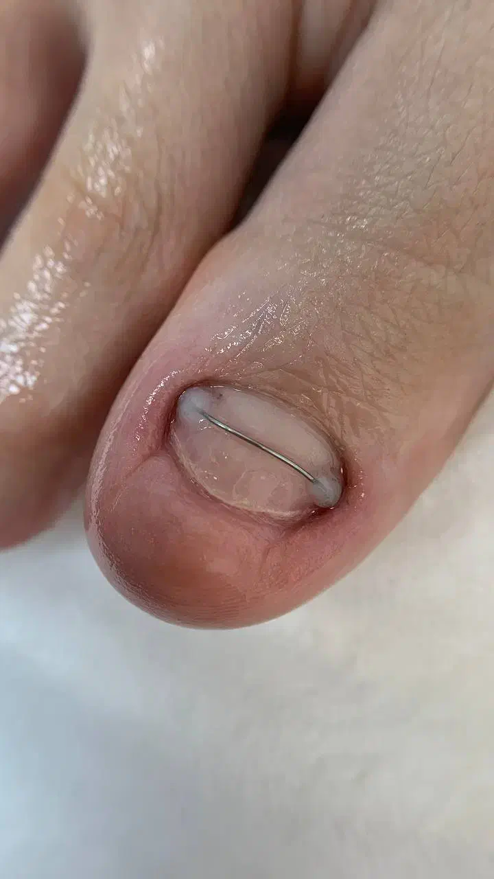 درمان ناخن های فرو رفته در گوشت|خدمات آرایشگری و زیبایی|تبریز, |دیوار