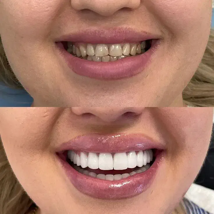 لبخندی رویایی با متریال برند های برتر کامپوزیت|خدمات آرایشگری و زیبایی|یاسوج, |دیوار