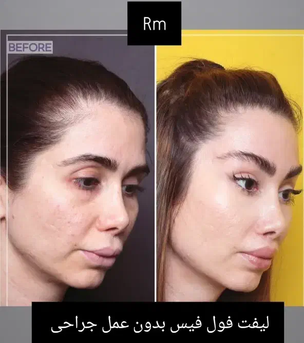 لیفت فول فیس صورت لیفت چشم گربه ای بدون عمل جراحی|خدمات آرایشگری و زیبایی|ری, دیلمان|دیوار