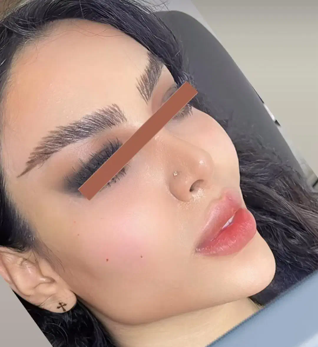 غبغب بلفارو ژل بوتاکس پیکرتراشی|خدمات آرایشگری و زیبایی|تهران, میرداماد|دیوار