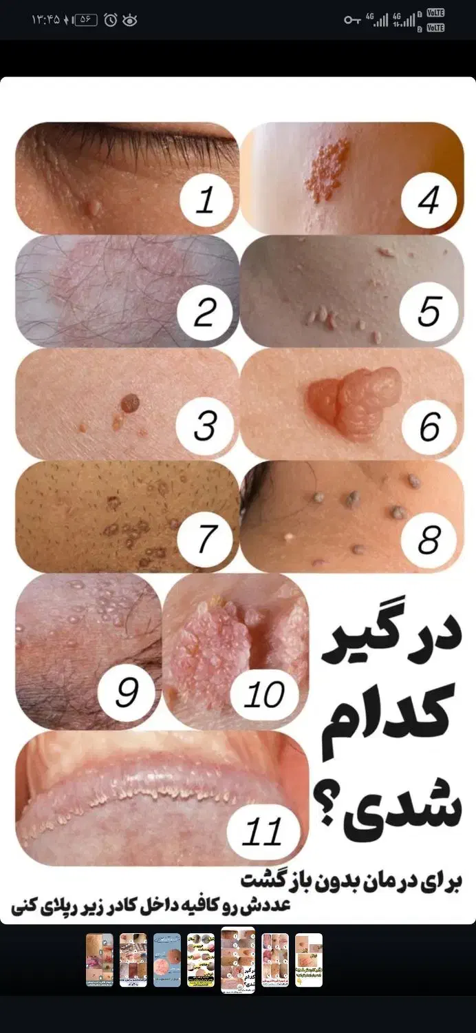 رفع دائمی زگیل و تبخال تناسلی|آرایشی، بهداشتی، درمانی|قزوین, |دیوار