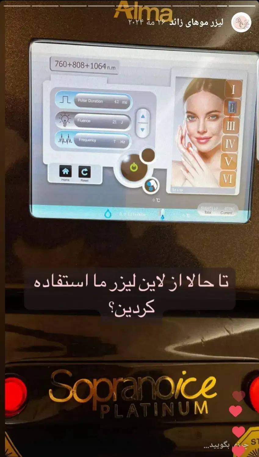 لیزر ونوس با دستگاه Soprano ICE Platinum|خدمات آرایشگری و زیبایی|تبریز, |دیوار