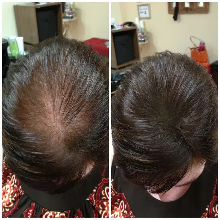 رفع ریزش مو کاملاگیاهی|آرایشی، بهداشتی، درمانی|احمدی, |دیوار