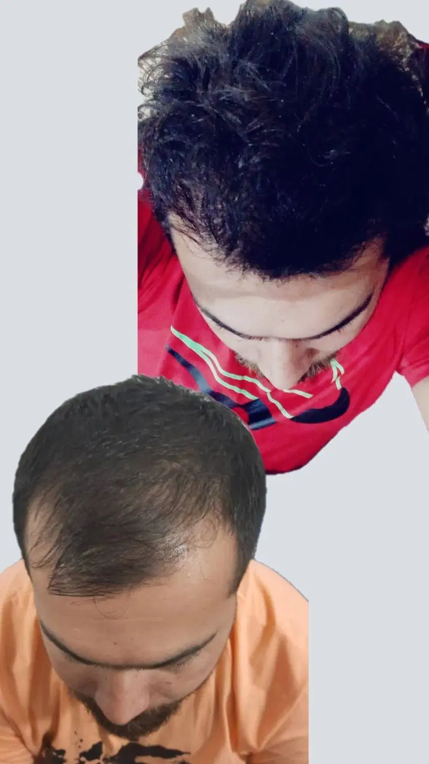 تکنسین تهرانی کاشت مو و کاشت ابرو در کرمانشاه|خدمات زیبایی و سلامت|کرمانشاه, |دیوار