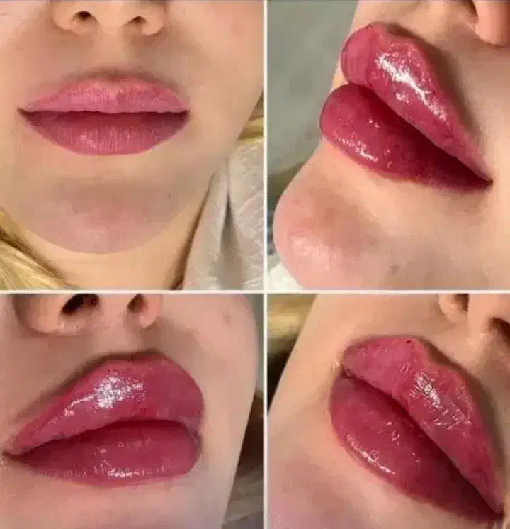 تزریق بوتاکس فیلر انزیم prp مزوتراپی جوانسازی|خدمات آرایشگری و زیبایی|کرمانشاه, |دیوار