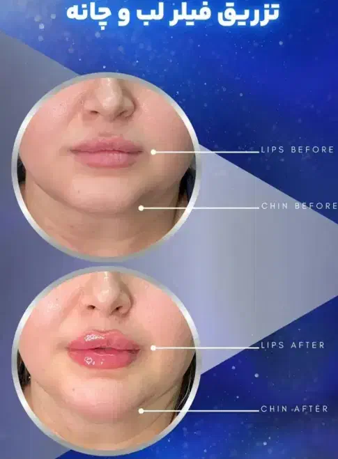 تزریق انواع فیلر بوتاکس مزوژل ها توسط پزشک|خدمات آرایشگری و زیبایی|گرگان, |دیوار