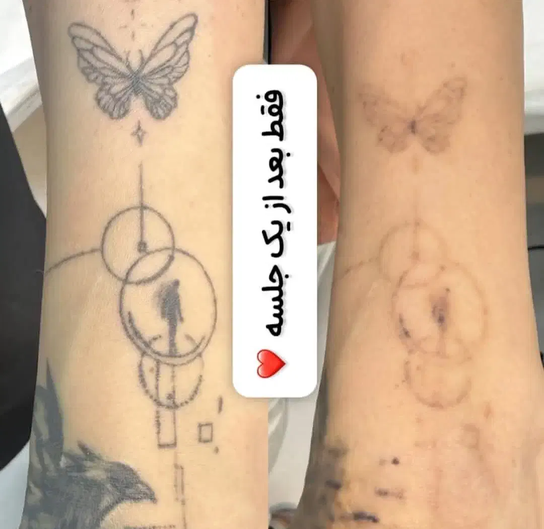 خال برداری، پاک کردن تتو، بلفاروپلاستی در تهران|خدمات آرایشگری و زیبایی|باقرشهر, |دیوار