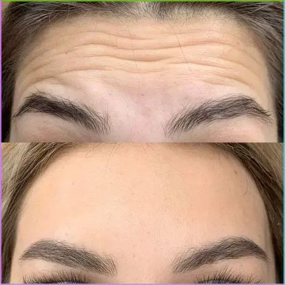 کاشت ابرو/فیشال/تزریق فیلر/لیپوابدو/پی ار پی|خدمات آرایشگری و زیبایی|پیشوا, |دیوار