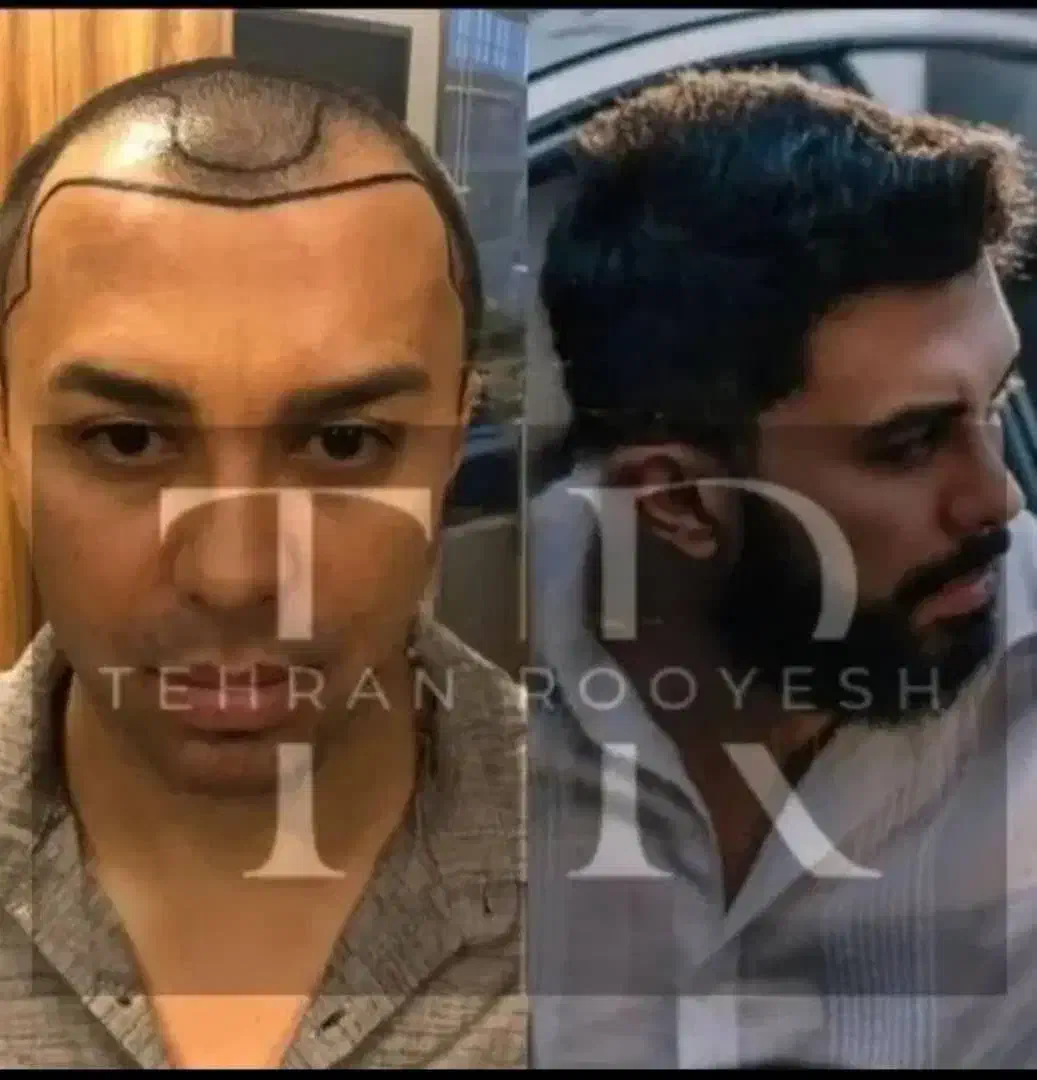 جشنواره یلدایی کاشت مو در تهران یک روزه|خدمات آرایشگری و زیبایی|تهران, جماران (نیاوران)|دیوار