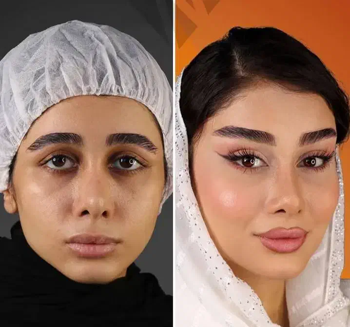 بلفاروپلاستی لیفت صورت بوکال فت تزریق چربی|خدمات آرایشگری و زیبایی|کرمانشاه, |دیوار