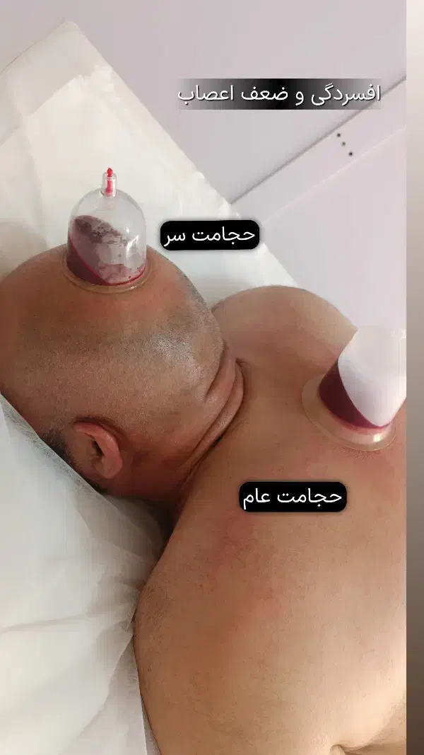 آموزش دوره تخصصی حجامت فصد زالو بادکش|خدمات آموزشی|کرج, کمال‌شهر|دیوار