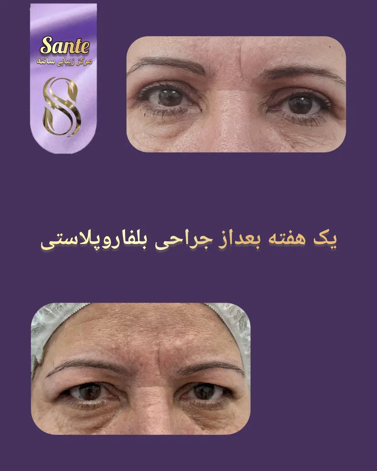 بوتاکس رایگان|خدمات آرایشگری و زیبایی|همدان, |دیوار