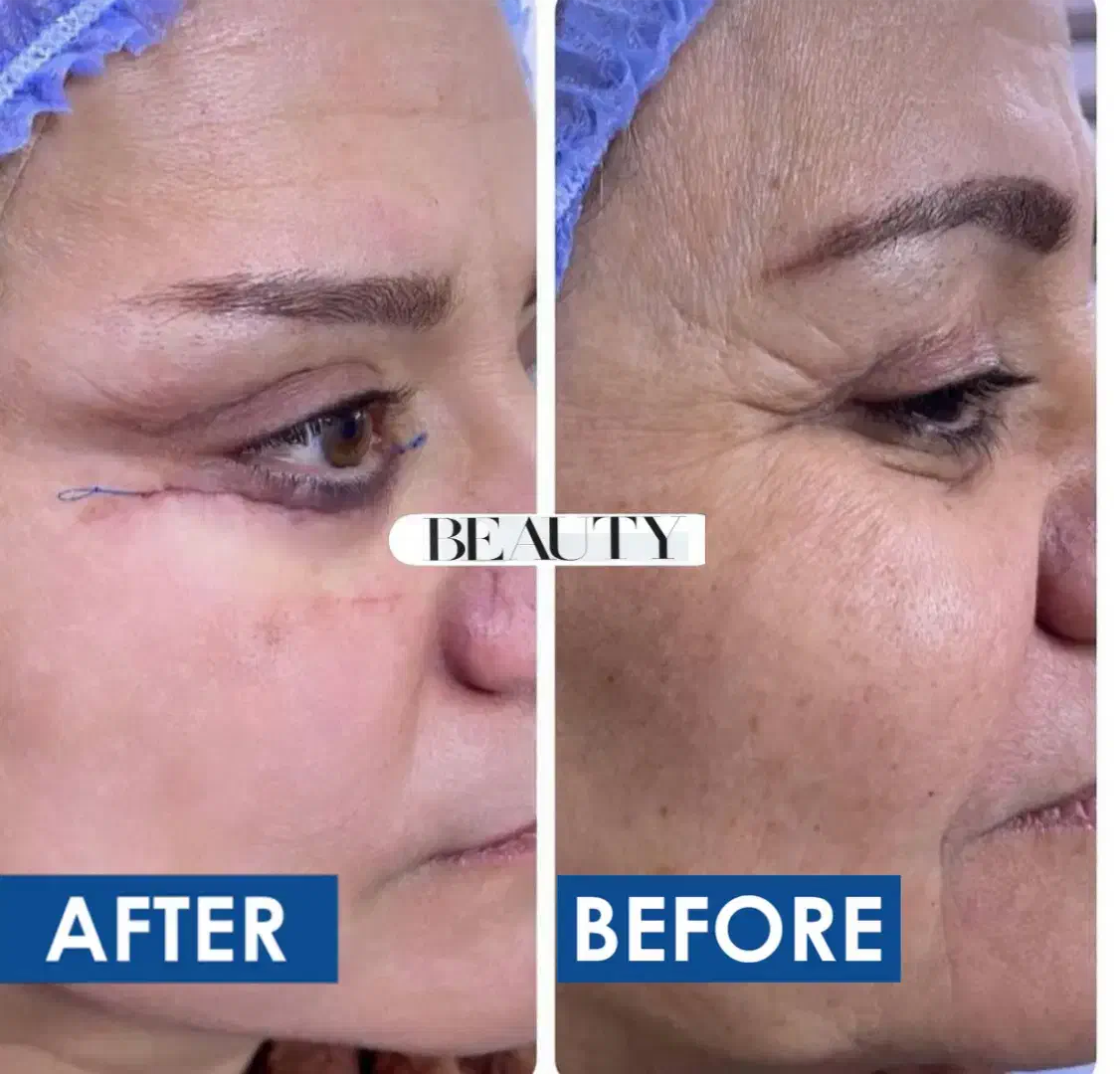 جشنواره بلفاروپلاستی و دیگر خدمات زیبایی|خدمات آرایشگری و زیبایی|کرمانشاه, |دیوار