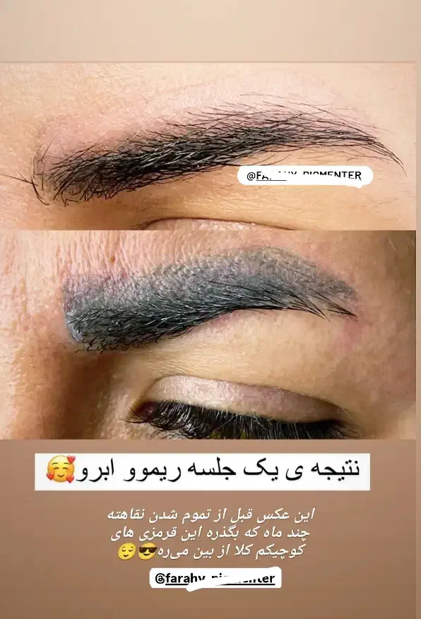 آموزش ریموو تاتو|خدمات آموزشی|گرگان, |دیوار