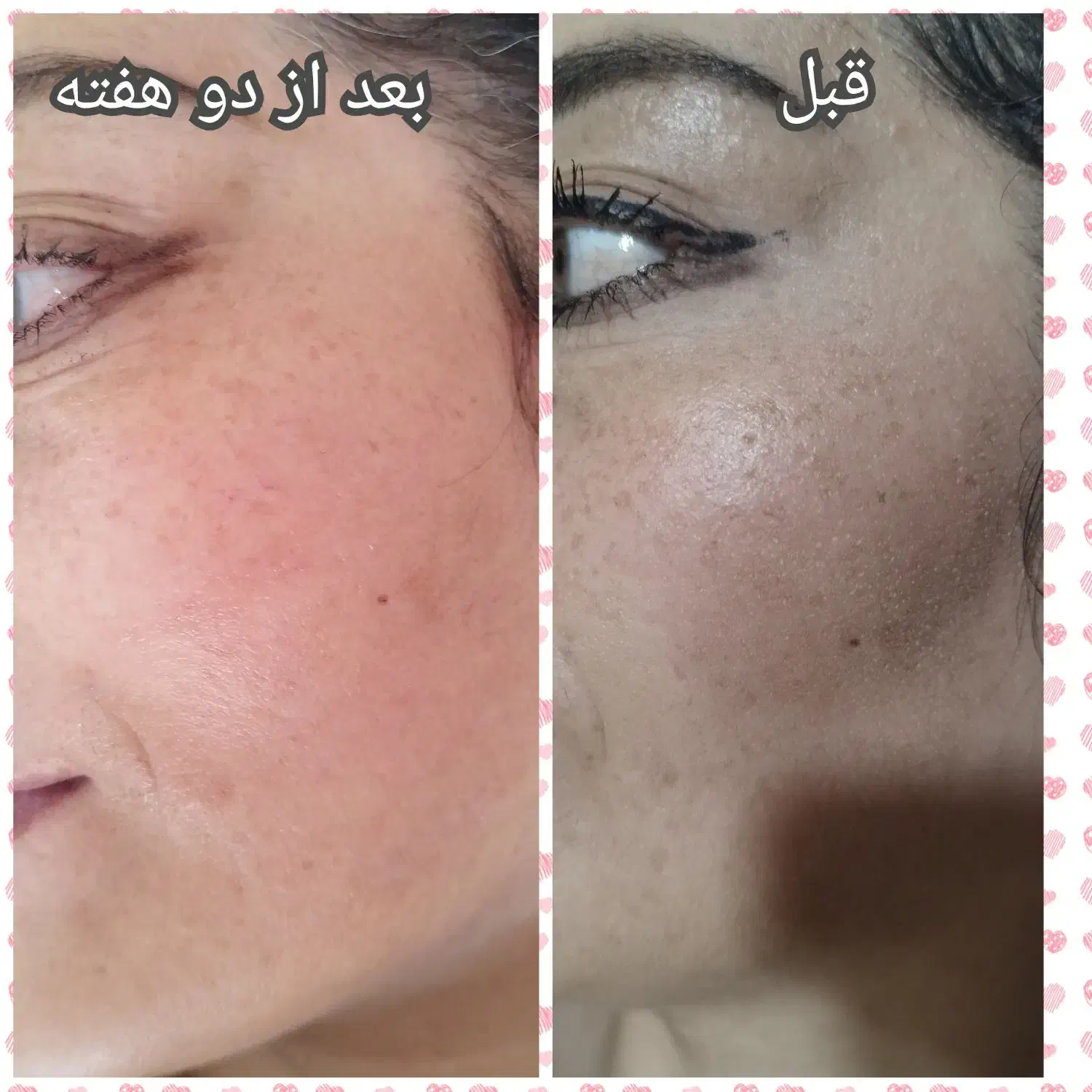 پاکسازی و جوانسازی پوست با آکوا فیشیال|خدمات آرایشگری و زیبایی|اردبیل, |دیوار