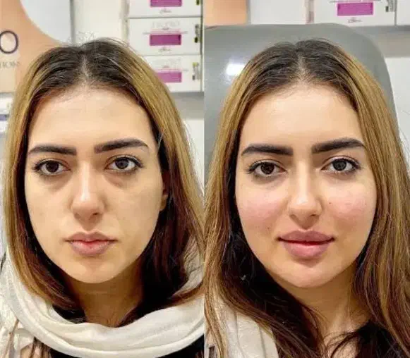 اف یلدایی خدمات ژل و بوتاکس|خدمات آرایشگری و زیبایی|آبادان, |دیوار