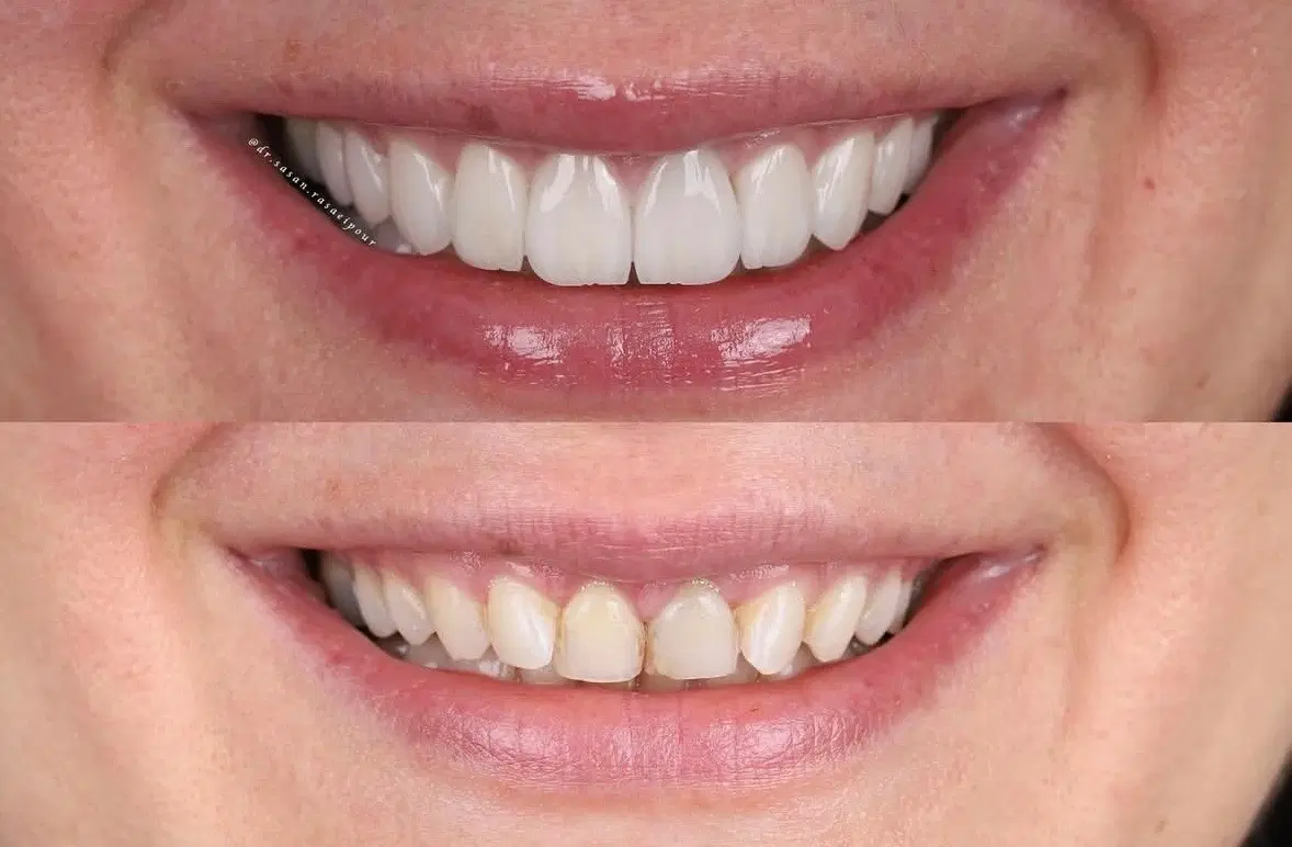 بیمار زیبایی لمینیت برای دوره دندانپزشکی|خدمات زیبایی و سلامت|تهران, امانیه|دیوار