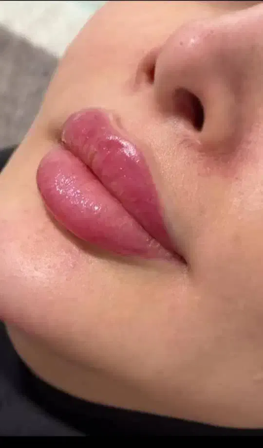 ژل و بوتاکس مزو ژل مزو تخفیفات 50 درصدی|خدمات آرایشگری و زیبایی|مشهد, فلسطین|دیوار