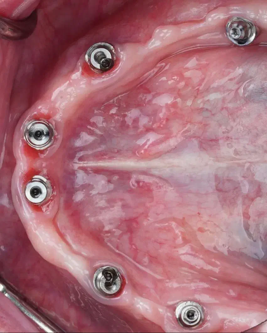 ایمپلنت با اقساط بلند مدت در تبریز|خدمات آرایشگری و زیبایی|اهر, |دیوار