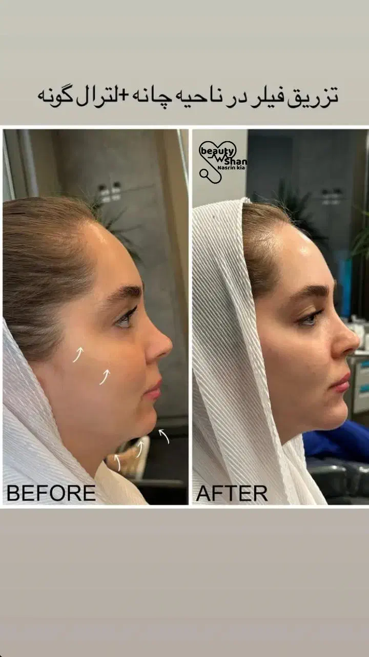 خدمات زیبایی ساکشن و تزریق فیلر های بادی|خدمات آرایشگری و زیبایی|خرمآباد, |دیوار